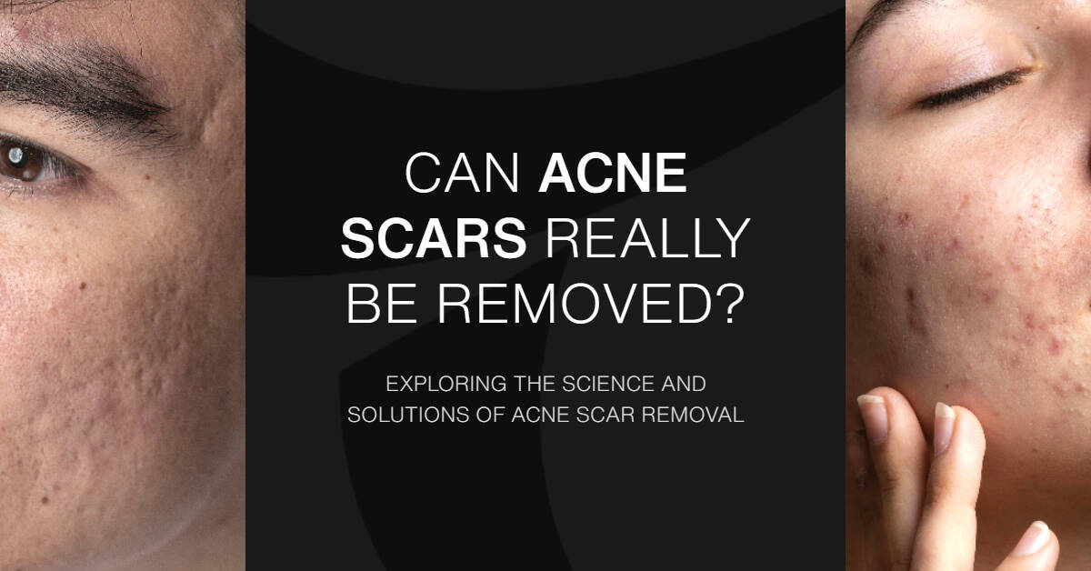 Acne Scar Removal Singapore Can Acne Scars Really Be Removed? Coslab
